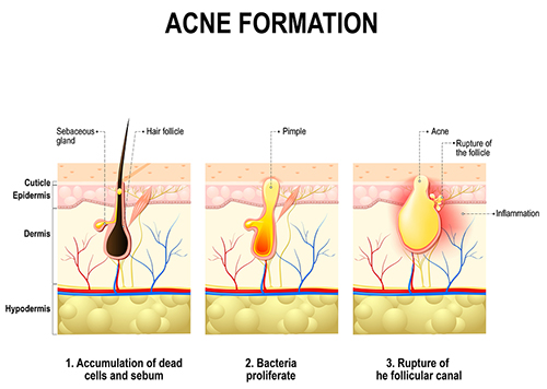 Acne Treatments Formation