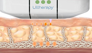 Ultherapy® 