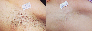 Click Here to View More Laser Hair Removal Before & After Photos