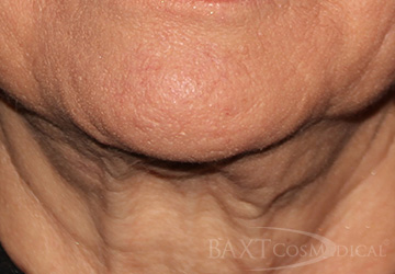 Closeup of patient Before Ultherapy® Treatment