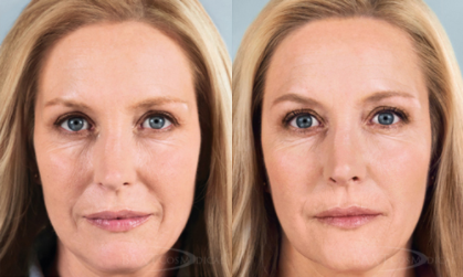 Click Here to View More Facial Filler Before & After Photos