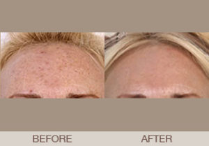 Fraxel® Dual Laser Resurfacing