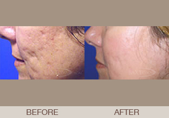 Fraxel Laser Before & After Photos Bergen County