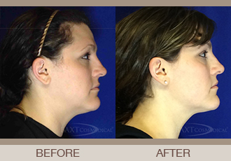 Click Here to View More Ultherapy® Before & After Photos