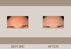 Isolaz® Acne Treatment Gallery