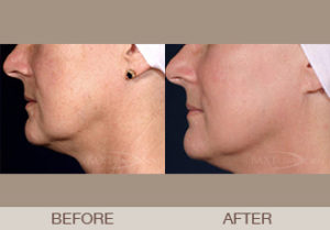 Fraxel® Dual Laser Resurfacing