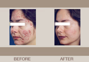 Isolaz® Acne Treatment Gallery