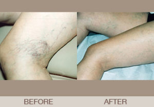 Leg Vein Treatment Gallery