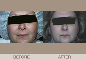 Photofacial Gallery