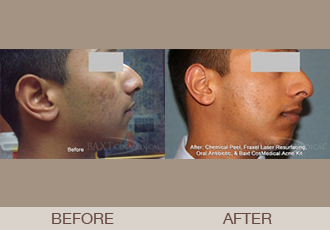 Click Here to View More Acne Treatments Before & After Photos