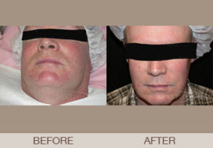 Photofacial Gallery