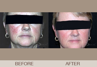 Photofacial Gallery