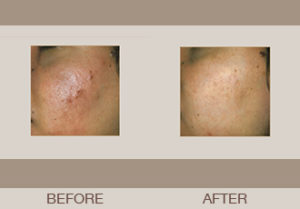 Isolaz® Acne Treatment Gallery