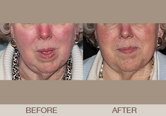 Click Here to View More Photofacial / IPL Before & After Photos