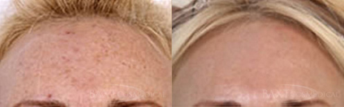 Fraxel® Dual Laser Treatments Before & After Photos