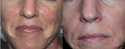 Intense Pulsed Light Before & After Photos