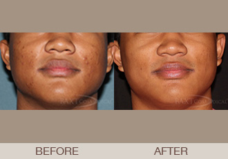 Click Here to View More Acne Treatment Before & After Photos