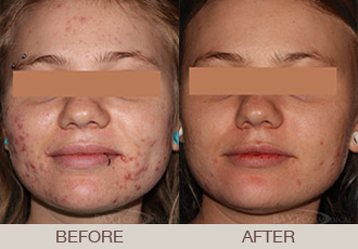 Click Here to View More Medical Acne Treatment Before & After Photos