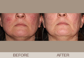 Click Here to View More IPL Before & After Photos