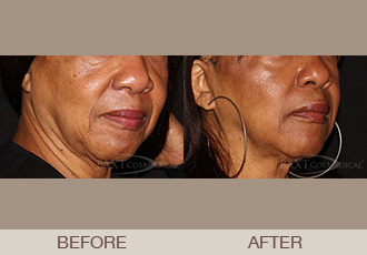 Facial Fillers Before & After - Paramus, NJ