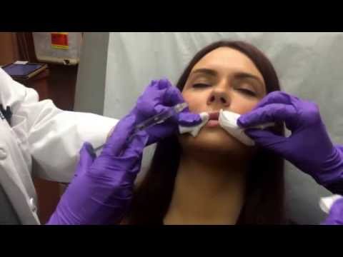 Juvéderm Injection by Dr. Rebecca Baxt to enhance patient lips