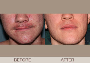 Acne Treatment Gallery