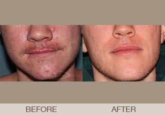 Click Here to View Acne Treatments Before & After Photos