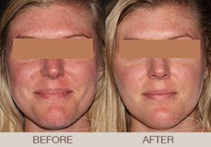 Rosacea Treatment Gallery