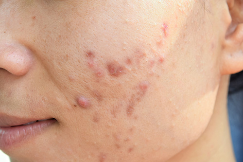 Closeup of Acne