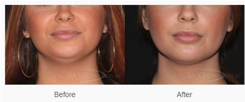 Click Here to View More Kybella® Before & After Photos