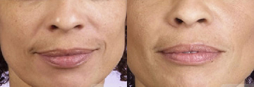 Click Here to View More Juvéderm<sup>®</sup> Before & After Photos