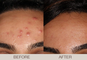 Acne Treatment Gallery