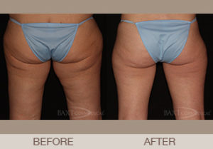 CoolSculpting® Gallery