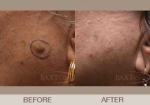 Mole & Lesion Removal Gallery