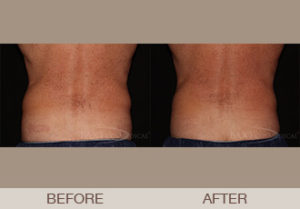 CoolSculpting® Gallery