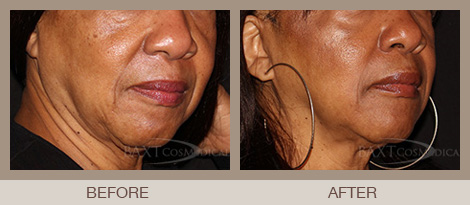  Cheek Volume Filler Bergen County