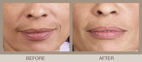 Lip Filler Bergen County