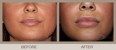 Lip Volume Filler Bergen County