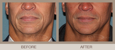 Volume Filler for Nasolabial Folds Bergen County