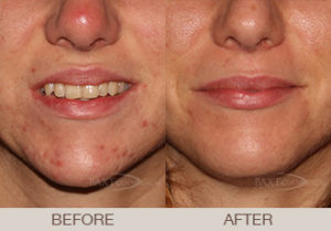 Wearing a mask has caused an increase in Acne which is called Maskne