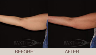 Click Here to View More CoolSculpting® Before & After Photos