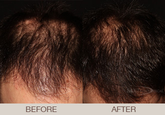 Hair Restoration (PRP) Before & After Photos Bergen County