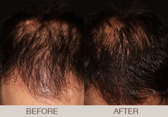 Hair Restoration Gallery - Non-Surgical Hair Loss Treatment Hair Restoration Gallery - Non-Surgical Hair Loss Treatment