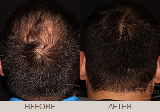 Hair Restoration (PRP) Before & After Photos Bergen County