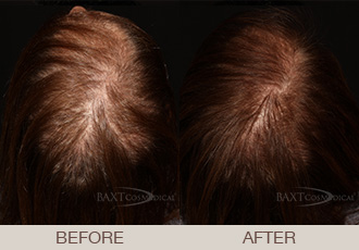 Hair Restoration Gallery