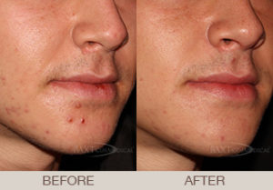 Acne Treatment Gallery