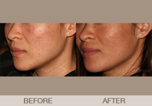 Fraxel & Fillers Before & After Photos Bergen County