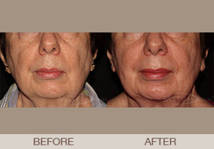 Photofacial Gallery