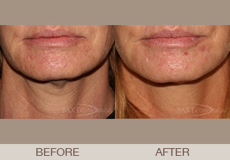 Click Here to View More Ultherapy® Before & After Photos
