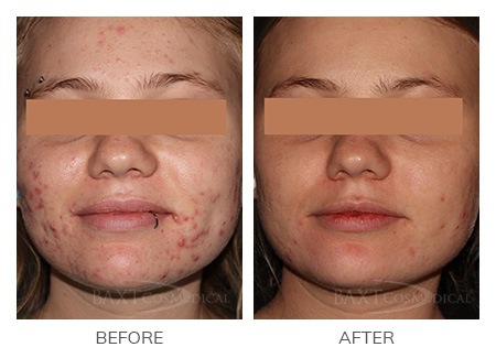 Click Here to View Acne Treatment Before & After Photos Click Here to View Acne Treatment Before & After Photos